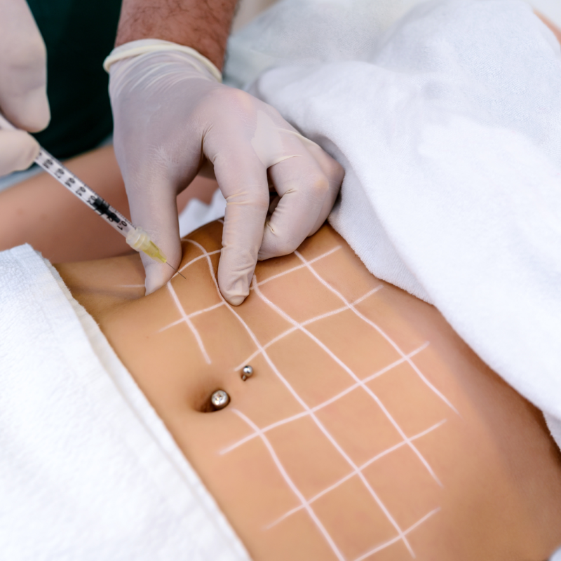 Body mesotherapy